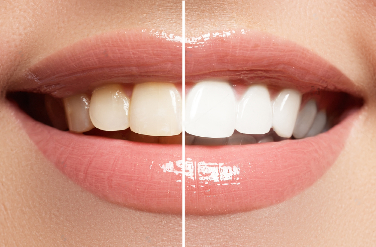 teeth whitening st. catharines