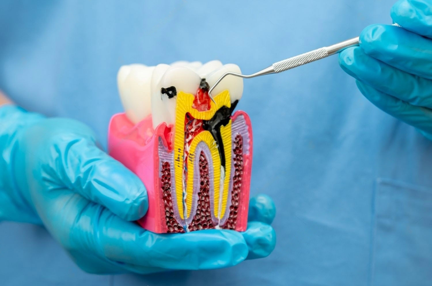 root canal st. Catharines emergency dentist
