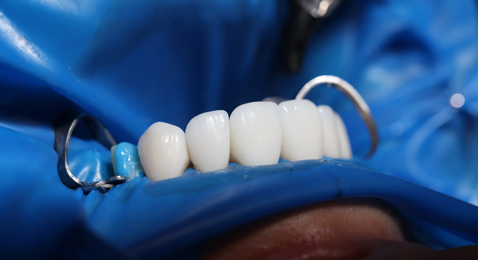 Dental Veneers St. Catharines