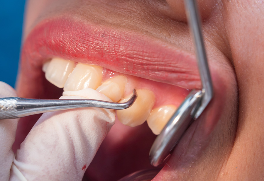 dental plaque