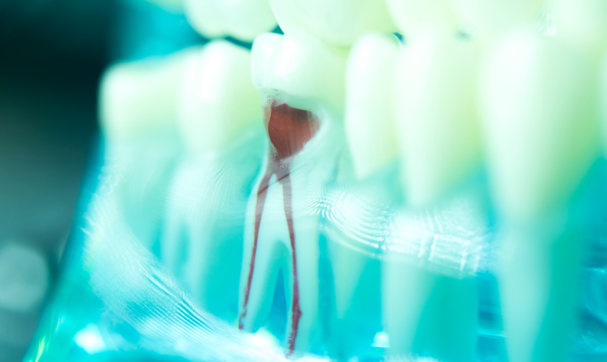 Root Canal St. Catharines